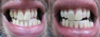 Zoom Teeth Whitening