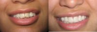 Patient treated with Cosmetic Dentistry