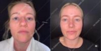 Woman treated with Rhinoplasty