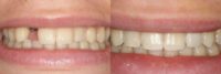 55-64 year old man treated with Dental Implants
