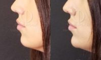 18-24 year old woman treated with Injectable Fillers