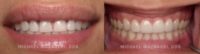 25-34 year old woman treated with Natural Porcelain Veneers