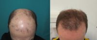 55-64 year old man treated with FUE Hair Transplant