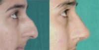 Rhinoplasty