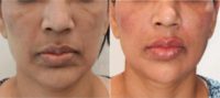 Face Contouring with Dermal Fillers
