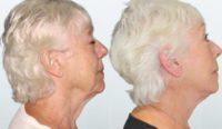 75 and up year old woman treated with Facelift, Neck Lift