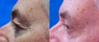 55-64 year old man treated with Eyelid Surgery