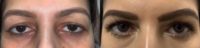 Woman treated with Eyelid Surgery