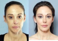 35-44 year old woman treated with Non Surgical Face Lift