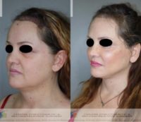 53 year old woman treated with Facelift
