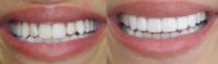 25-34 year old woman treated with Porcelain Veneers