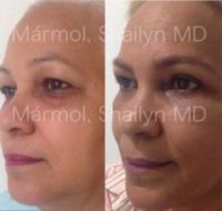 55-64 year old woman treated with Eyelid Surgery