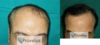 Norwood VI after 3750 FUE Hair Transplant