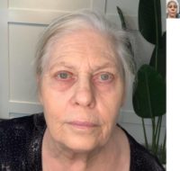 65-74 year old woman treated with Morpheus8: Face, Eyes (M8 Prime), and PRP