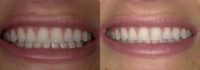 25-34 year old woman treated with Teeth Whitening