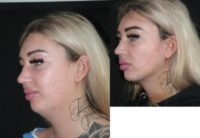 25-34 year old woman treated with Chin Liposuction