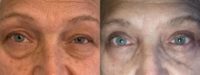 75 and up year old woman treated with Eyelid Surgery