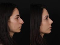 18-24 year old woman treated with Preservation Rhinoplasty