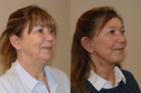 55-64 year old woman treated with facelift & necklift