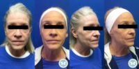 55-64 year old woman treated with Sculptra Aesthetic, Dermal Fillers
