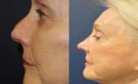 65-74 year old woman treated with Rhinoplasty