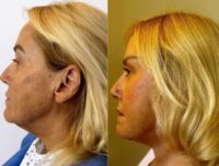 Woman treated with Neck Lift, Facelift