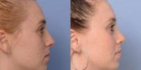 Woman treated with Rhinoplasty