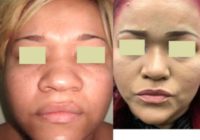 25-34 year old woman treated with African American Rhinoplasty