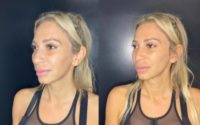 35-44 year old woman treated with Dermal Fillers