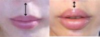 25-34 year old woman treated with Lip Lift