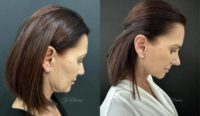 45-54 year old woman treated with Rhinoplasty, Facelift