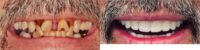 45-54 year old man treated with All-on-4 Dental Implants