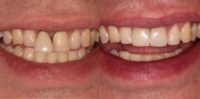 25-34 year old man treated with Dental Implants