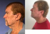 65-74 year old man treated with Neck Lift