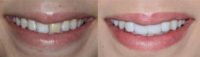 18-24 year old woman treated with Porcelain Veneers