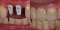 35-44 year old man treated with Dental Implants