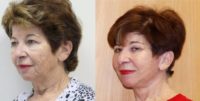 55-64 year old woman treated with Facelift and Autologous fat transfer