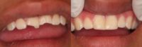 Dental Front Teeth Bonding