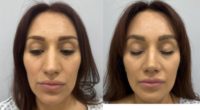 35-44 year old woman treated with Rhinoplasty, Chin Liposuction, FaceTite