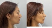 35-44 year old woman treated with Rhinoplasty, Chin Liposuction, FaceTite