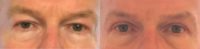Eyelid Reduction Surgery
