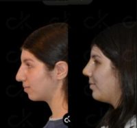 18-24 year old woman treated with Rhinoplasty