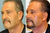 Man treated with Facelift