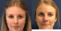 25-34 year old woman treated with Rhinoplasty