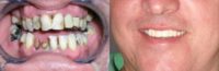Man treated with Dental Implants