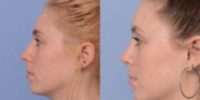 Woman treated with Rhinoplasty