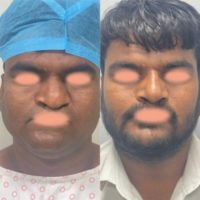 25-34 year old man treated with Cleft Rhinoplasty