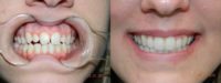 25-34 year old woman treated for Invisalign