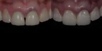 45-54 year old woman treated with Dental Crown