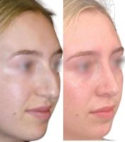 25-34 year old woman treated with Rhinoplasty